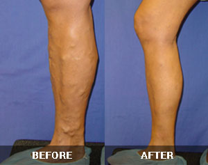 Varicose Veins Before and After 4