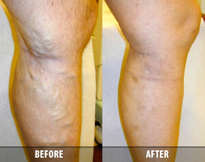 Varicose Veins Before and After 5