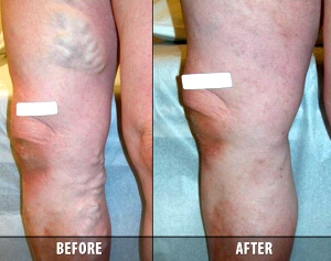 Varicose Veins Before and After 6