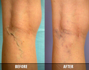 Varicose Veins Before and After 7