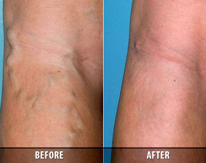 Varicose Veins Before and After 8