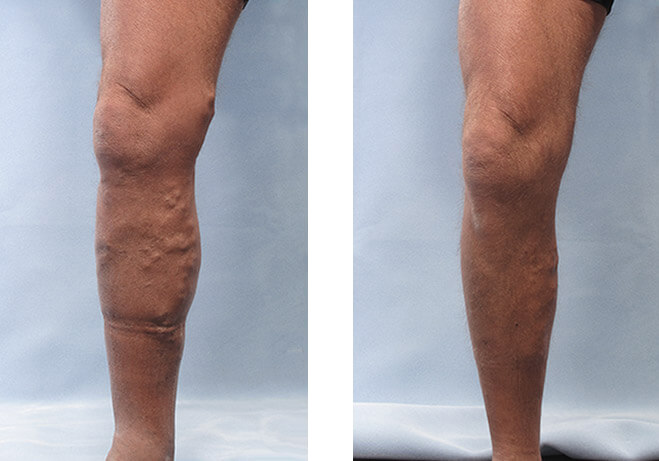 Varicose Veins Before and After