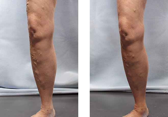 Varicose Veins Before and After 1