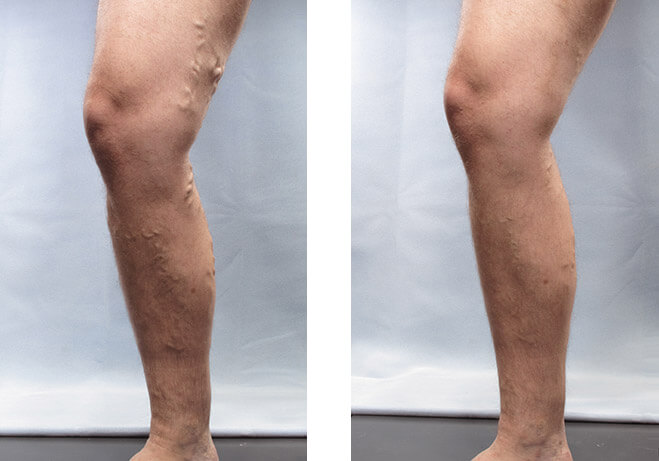 Varicose Veins Before and After 2