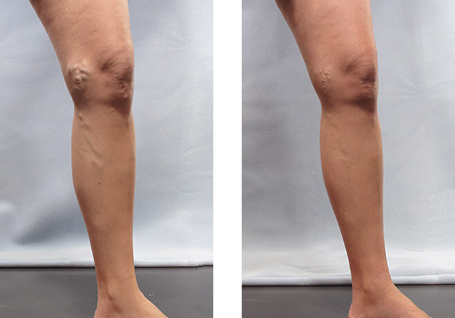 Varicose Veins Before and After 3
