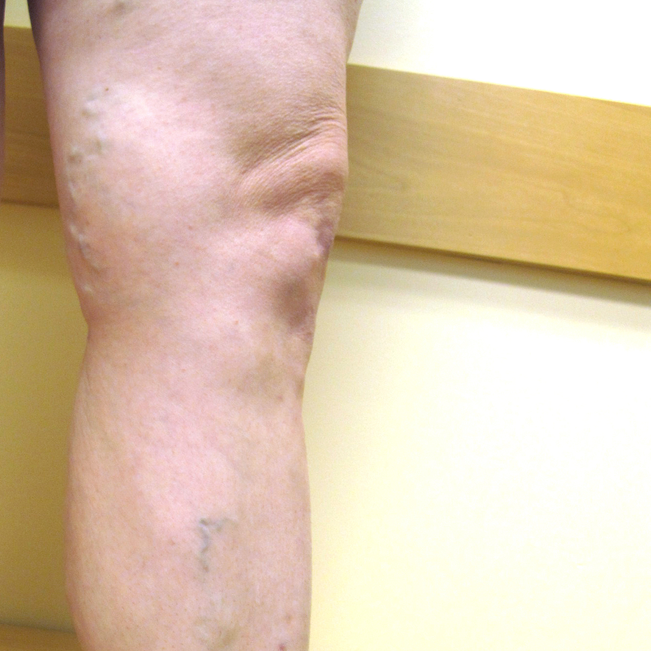 Varicose Veins After Treatment 1