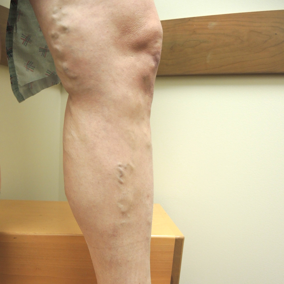 Varicose Veins Before Treatment 1