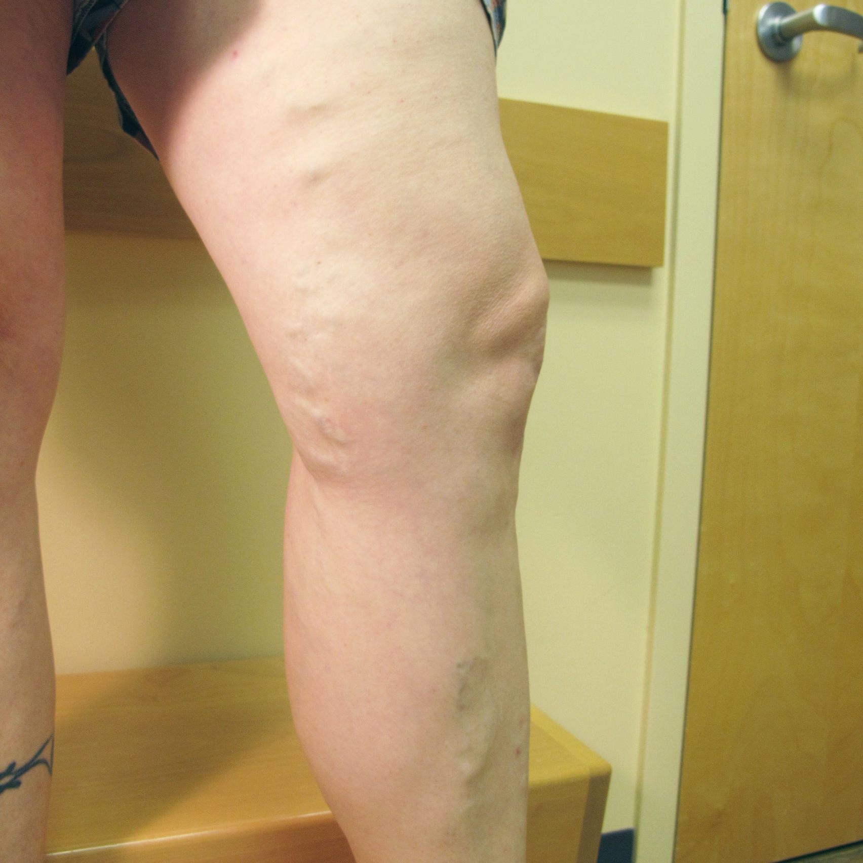 Varicose Veins After Treatment 2