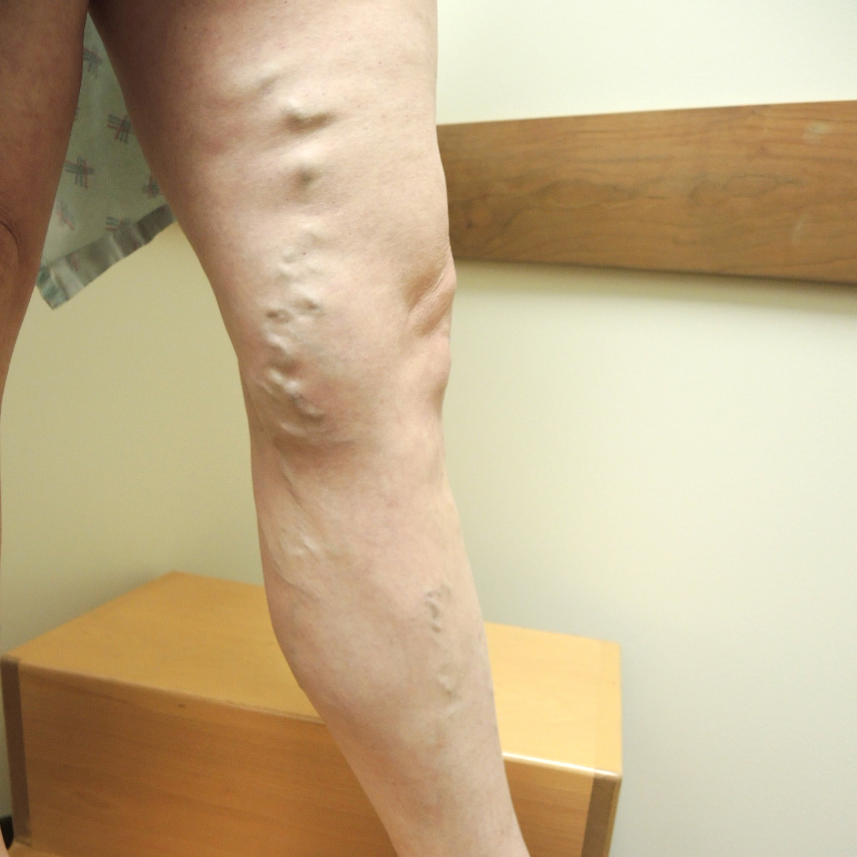 Varicose Veins Before Treatment 2