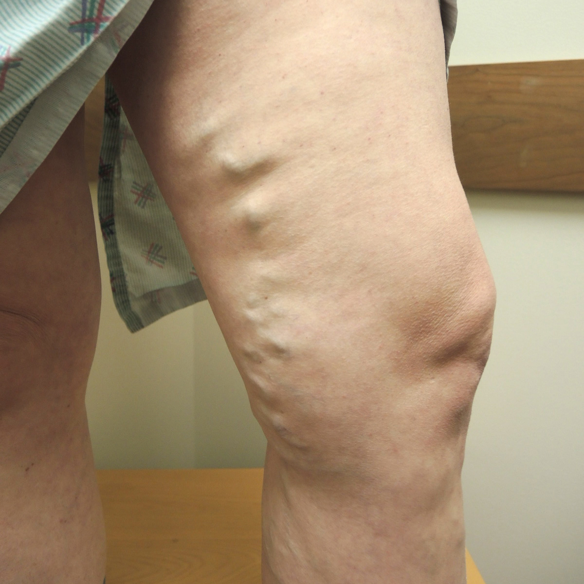 Varicose Veins Before Treatment 3