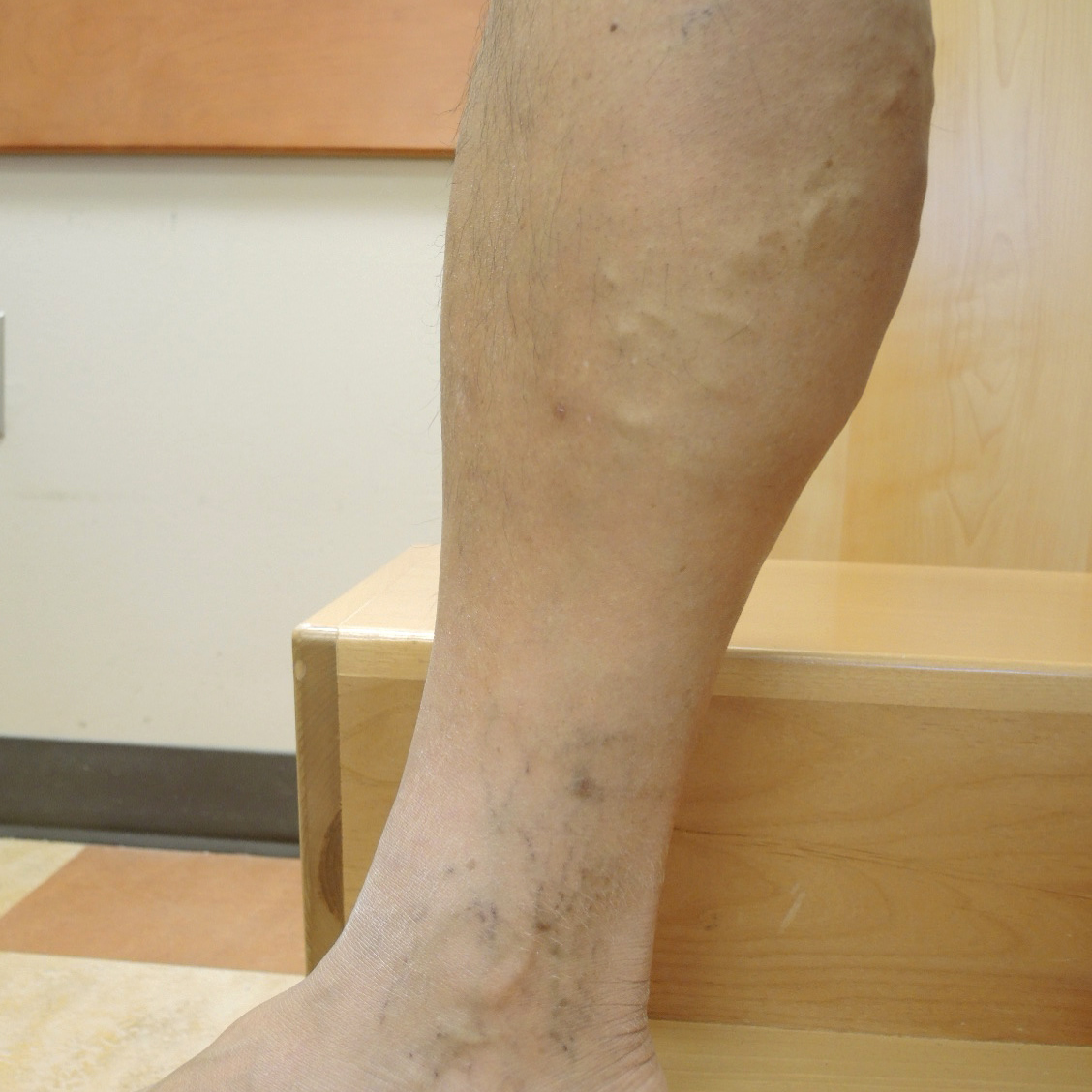 Varicose Veins After Treatment