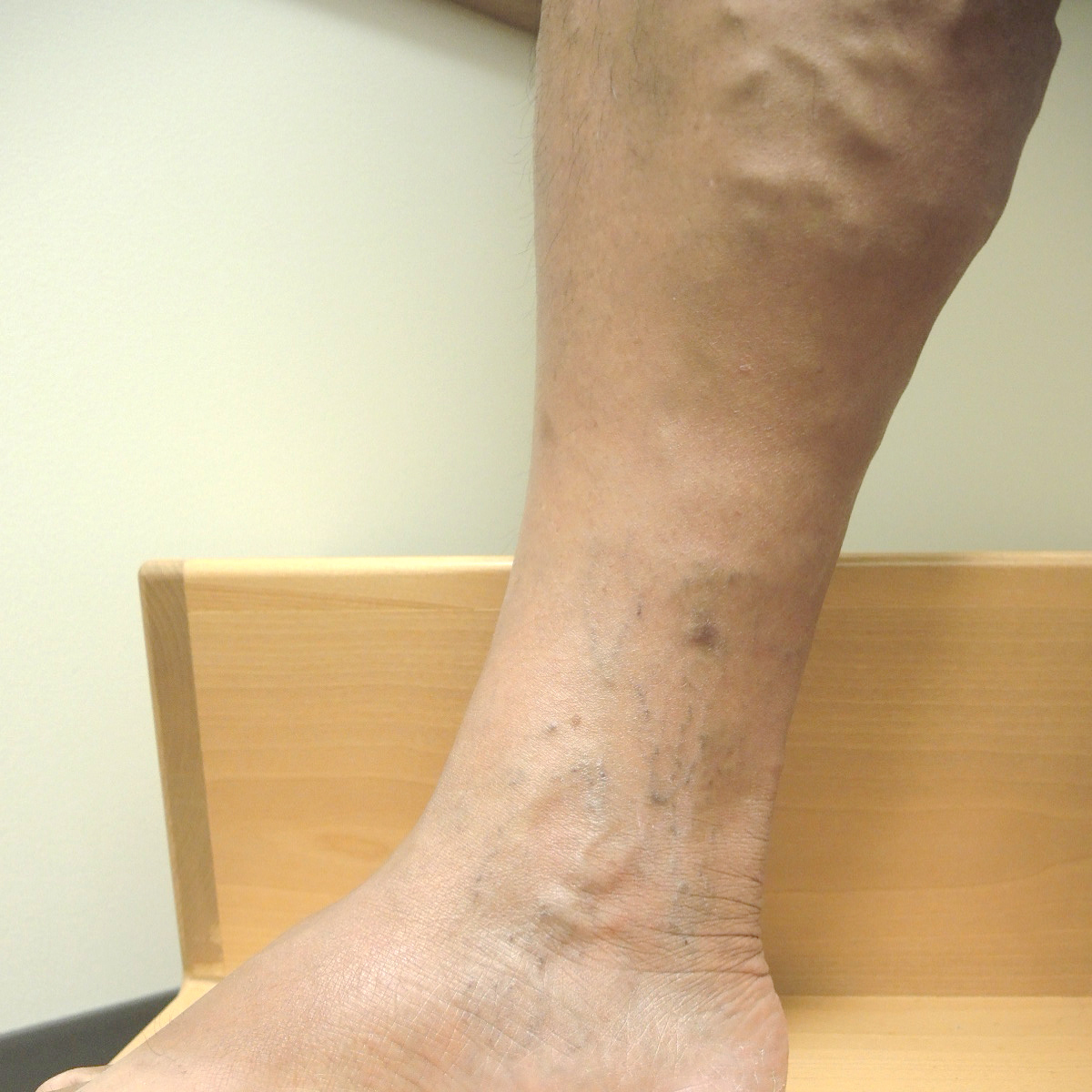 Varicose Veins Before Treatment