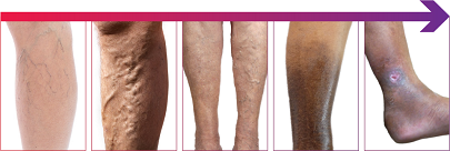 Spidervein Vein Removal Spidervein Treatment Arlington Heights IL